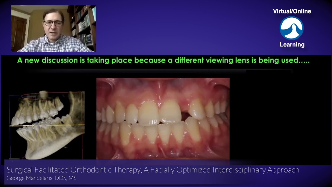 Surgical Facilitated Orthodontic Therapy, A Facially Optimized Interdisciplinary Approach - Short