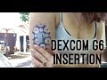 How to Change Dexcom G6 sensor & transmitter