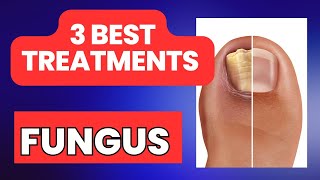 [REVEALED] 3 home remedies for nail fungus - Holistic Toenail Fungus Cures- fungal inflammation