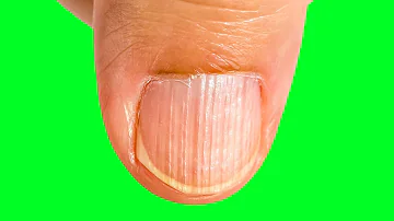 ¿Qué deficiencia hace que las uñas se partan verticalmente?