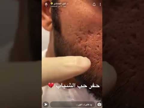 علاج ندبات حفر الشباب بتقطيع الالياف دكتور انور الحمادي