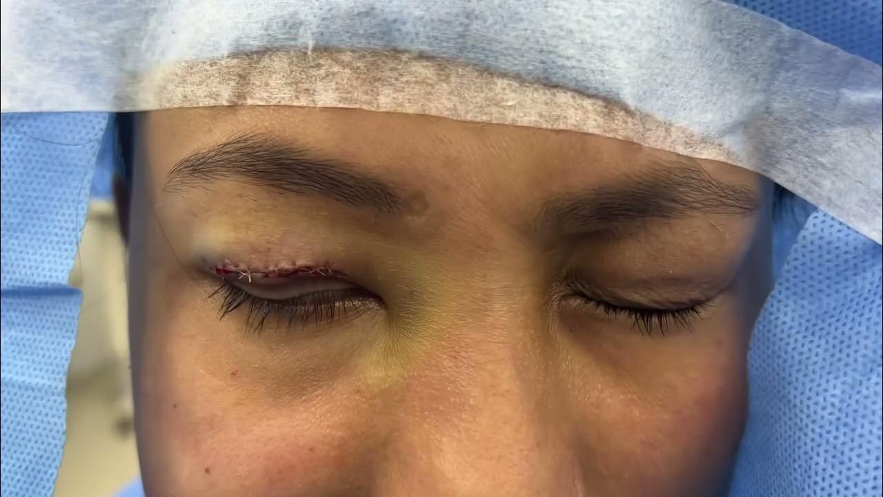 Best Oculoplastic Plastic Surgery Eyelid Lag Correction With Gold what-is-lag-time-in-hydrology-youtube