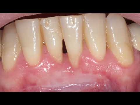 Zahnfleisch aufbauen / Freies Transplantat / Zahnfleischrückgang / Zahnfleischtransplantation
