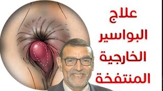 علاج البواسير الخارجية المنتفخة الدكتور محمد الفايد