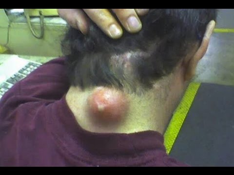 11+ Pickel Ausdrücken Youtube Video Images
