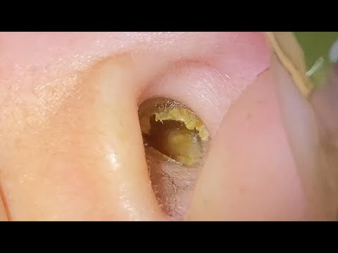 ASMR Ear Cleaning – So Deep, Even the Tools Struggled to Reach