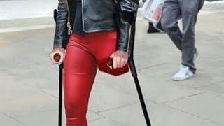 The Beautiful Woman Has An Amputated Leg, And Life With An Artificial Leg Is A Disability Challenge