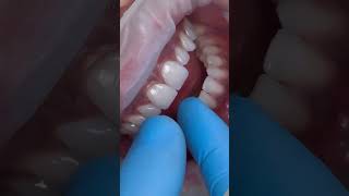 Dişlerde Aşındırma Olmadan Yapılmış Incecik Porselen Lamineler