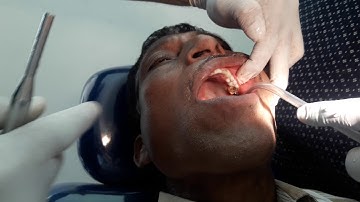 Bio- care dental implant placement by Dr Amit Oza