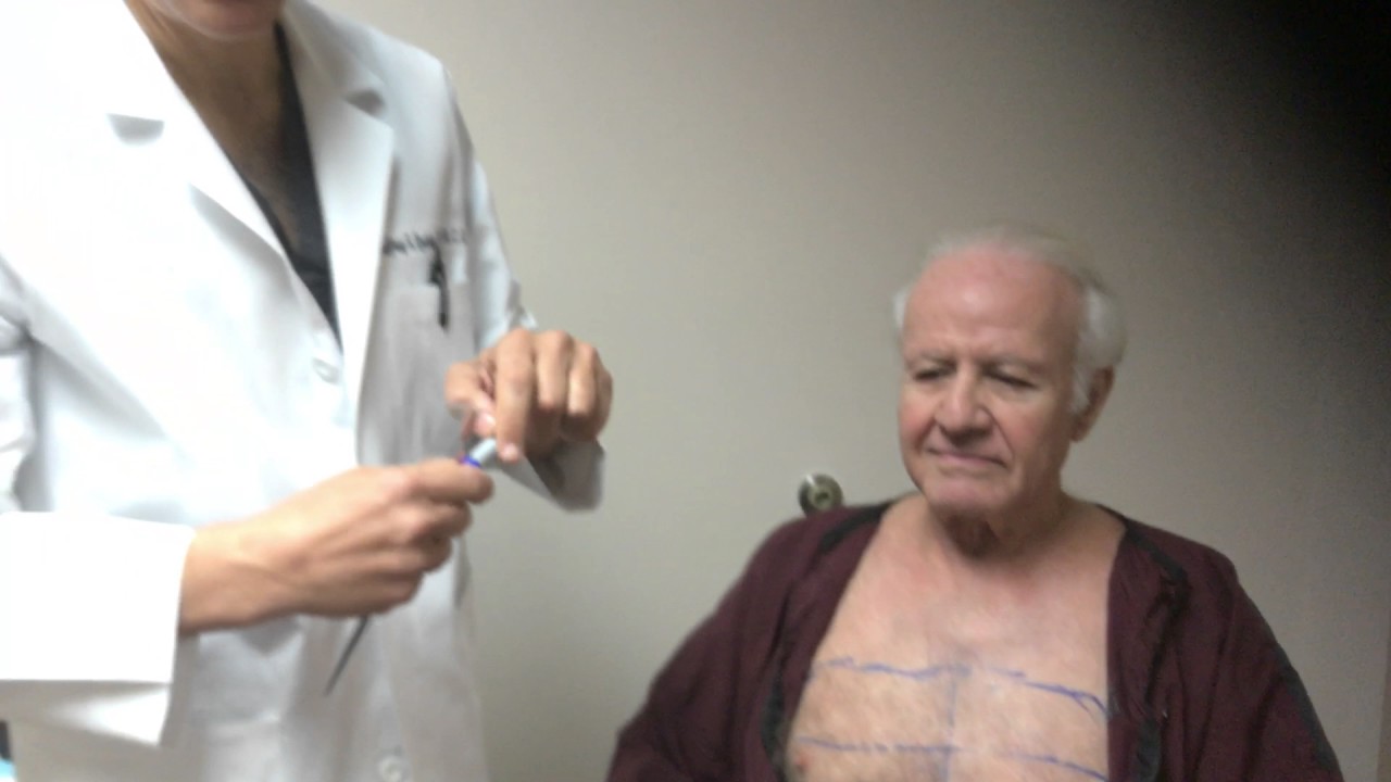 Body Hair Transplant (BHT) Chest Hairs to Scalp Dr. Jeffrey Epstein