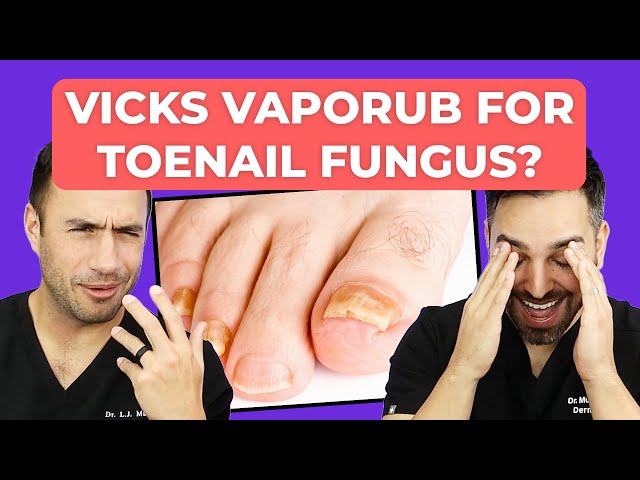 How to cure nail fungus of 15+ years : r/NailFungus