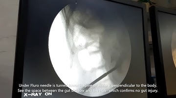 Prevent Colon or Gut Injury during PCNL, Dr Raj Kumar Sharma