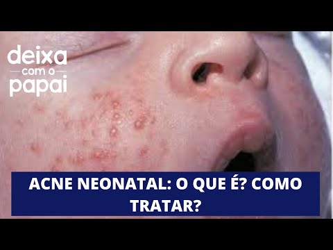 ACNE NEONATAL :O QUE É? DÓI? COMO TRATAR?DEIXA COMOPAPAI