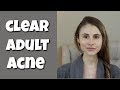 Adult acne what you need to know to clear your skin dr dray
