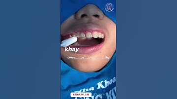 𝙂𝙖̆́𝙣 𝙖𝙩𝙩𝙖𝙘𝙝𝙢𝙚𝙣𝙩, 𝙜𝙞𝙖𝙤 𝙠𝙝𝙖𝙮 𝙞𝙣𝙫𝙞𝙨𝙖𝙡𝙞𝙜𝙣 #dentist #invisalign #shorts