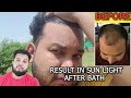 My True Results of Hair Transplant || best hair transplant in India (HINDI)