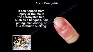 Paronychia Everything You Need To Know Dr Nabil Ebraheim Youtube