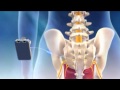 Overview of Sacral Nerve Stimulation for Urinary Control