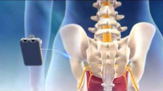 Overview of Sacral Nerve Stimulation for Urinary Control