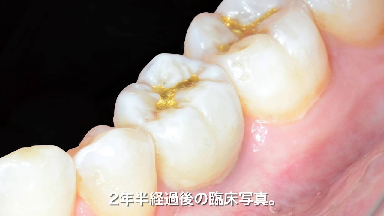 難しい下顎ケースでの正確なピンポイント埋入を可能にする皆川式インプラント Dr.皆川の「リスクを激減させるインプラント埋入法シリーズ