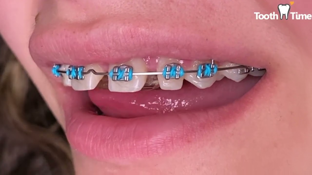 Braces On Checkups - Infinity ties - lace ties - power chains - Tooth Time Family Dentistry NBTX