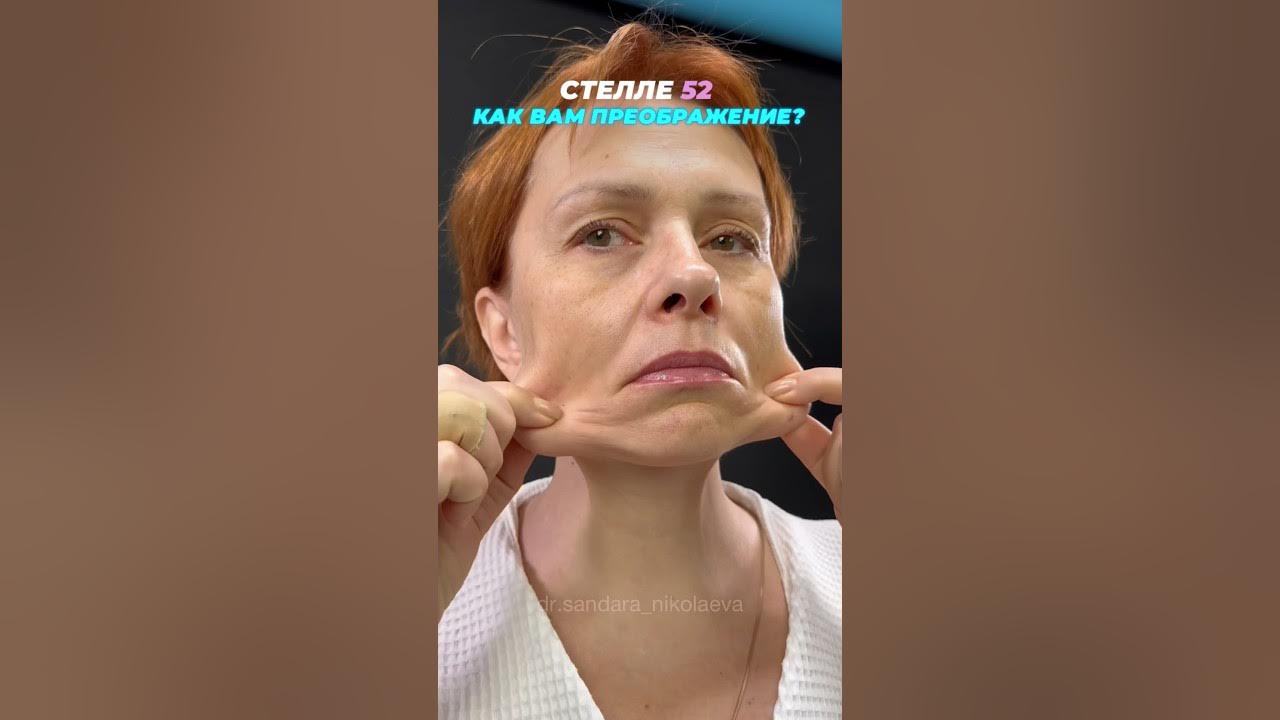 Это точно она?😳 Фейслифтинг. Малярный липолиз. Височный лифтинг. Доктор ...