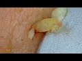 0330 keratin plug removal nose