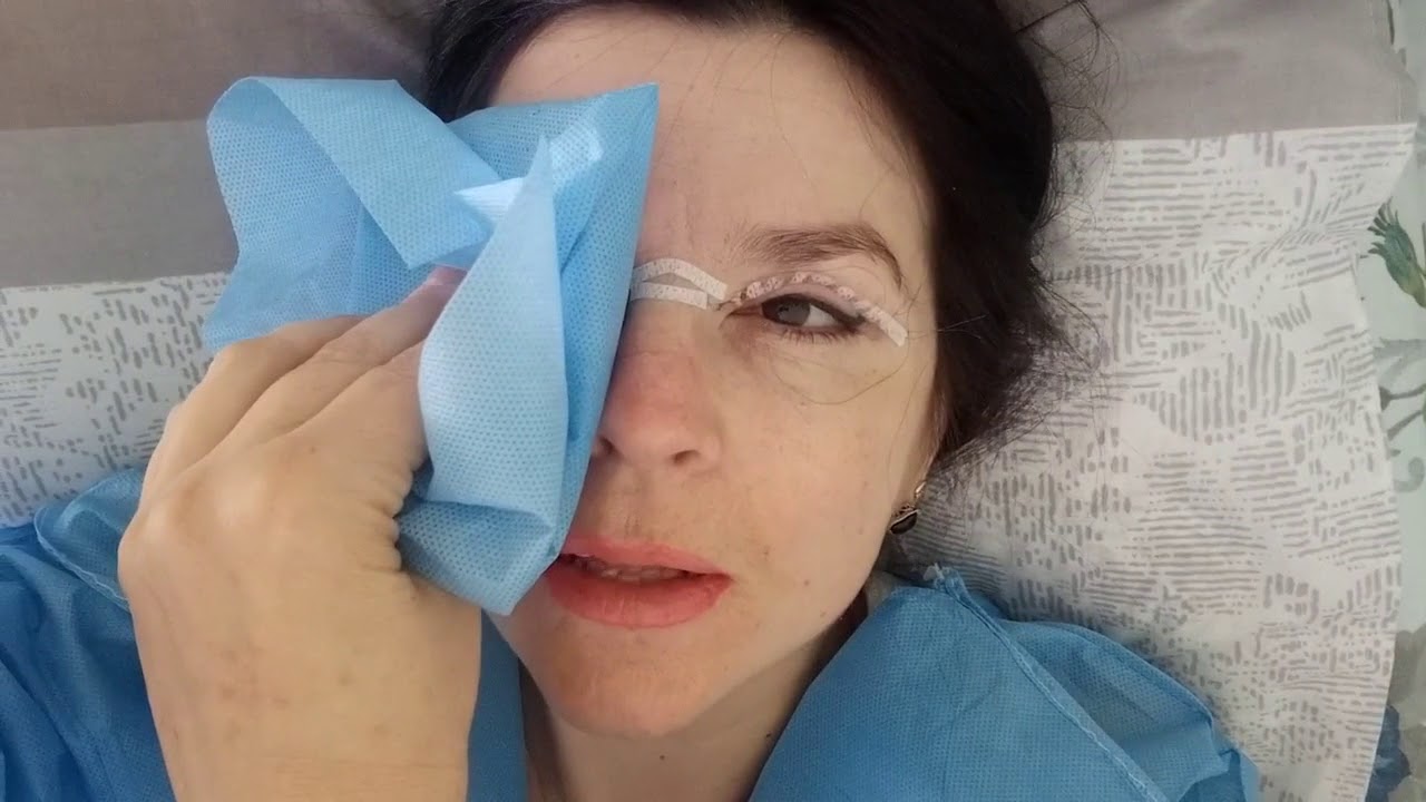 Есть ли жизнь после 50-ти:))) Первые минуты после  блефаропластики верхних век