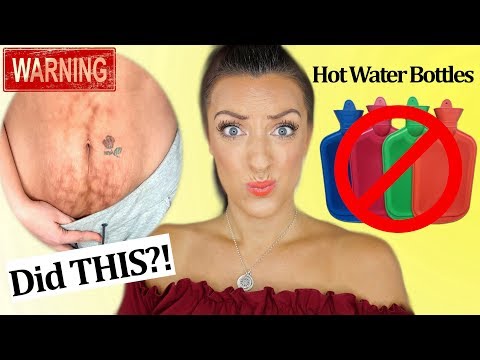 I DESTROYED MY TUMMY!! | Hot Water Bottle Rash and how I FIXED IT!