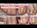 👣Salon Pedicure Big Toe Pain Ingrown Toenails Cleaning Transformation Part 2👣