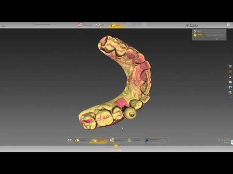 Atlantis inLab 18 Workflow