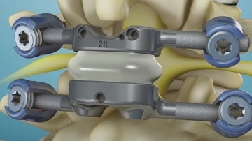 Novel TOPS back surgery now available in Colorado