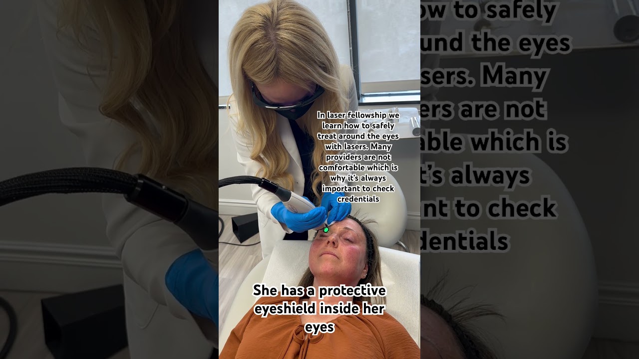 Vbeam around the eyes to treat ocular rosacea 