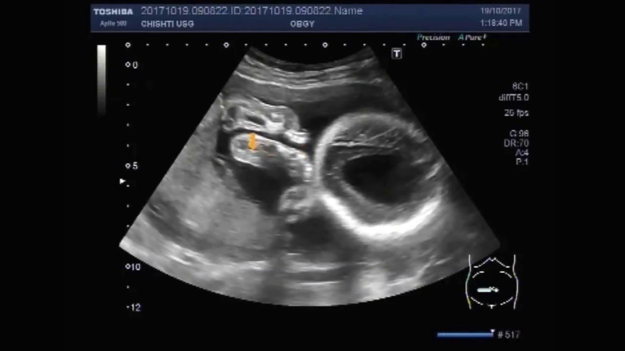 Ultrasound Video Showing Hydrocephalic Fetus Youtube
