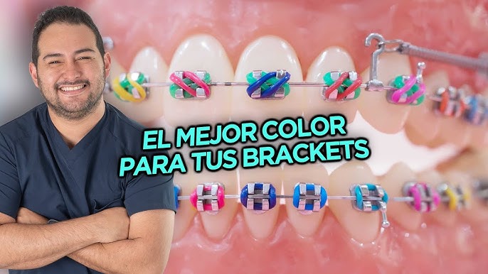 CÓMO ESCOGER EL COLOR DE LAS LIGAS DE TUS BRACKETS / How to choose the  color of your braces - YouTube