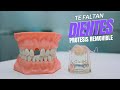 Como hacer protesis dental removible provisional con acrilico