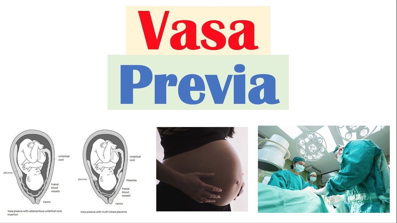 How Serious Is Vasa Previa?