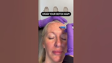 Draw Your Botox Map