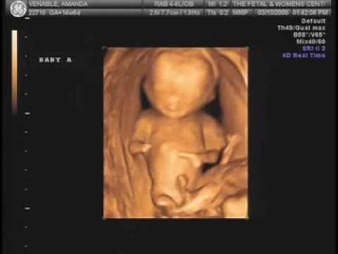 Twins 4d Ultrasound 14 weeks 6 days old. - YouTube