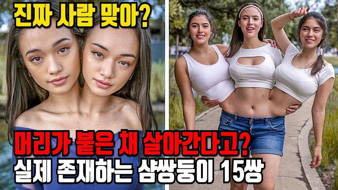 세상에 이런 쌍둥이가 있다고? 머리·심장·간까지… 믿기 힘든 현실｜샴쌍둥이 실화 TOP15