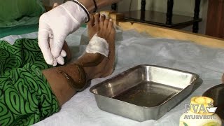 PVA: Raktamokshana - Leeches (Blood-Letting) Ayurveda Therapy