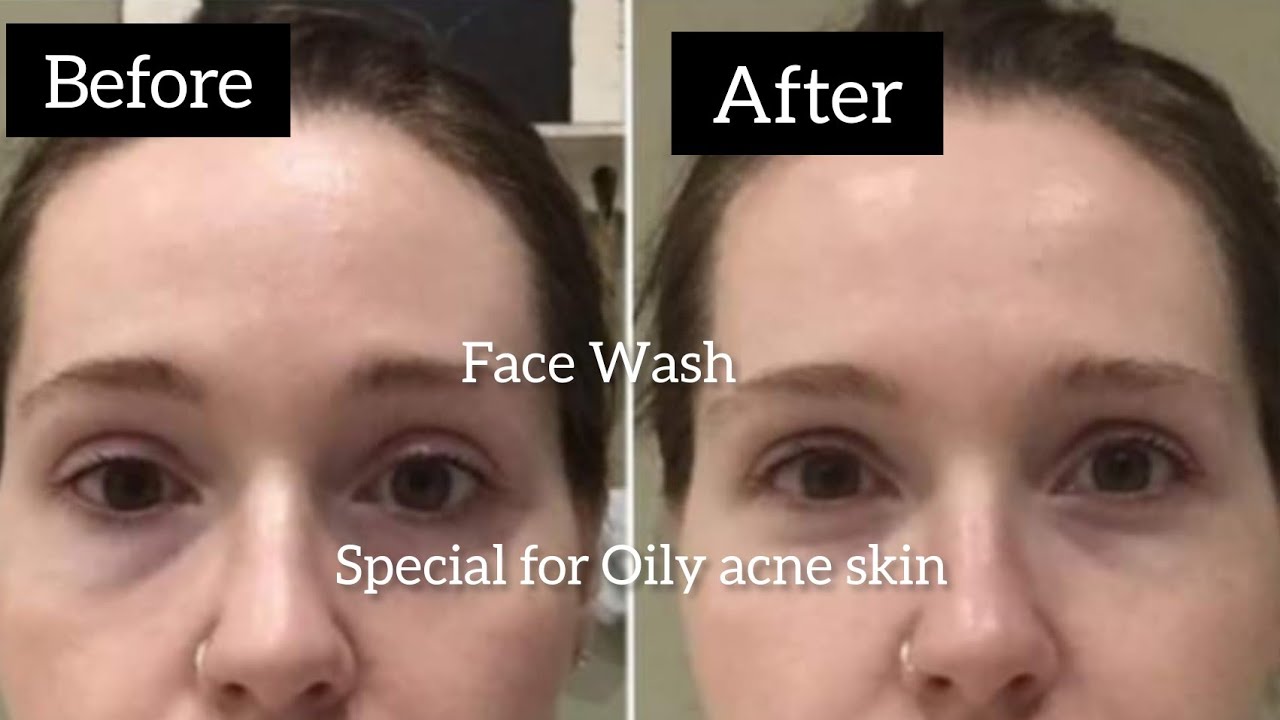 Best Oil Control Face Wash/Honest Review YouTube