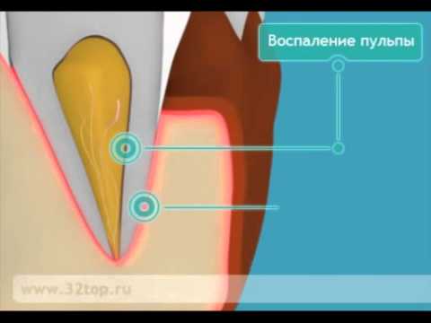 Видео: Периостит на долната челюст - лечение, периостит на долната челюст при деца