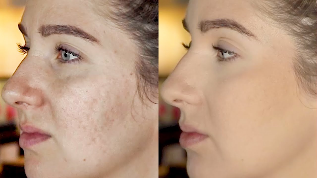 how to cover acne scars without makeup