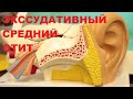 Экссудативный средний отит. Шунтирование барабанной полости.