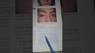 Ocular Features of Myasthenia Gravis – A Clinical Snapshot 👁️