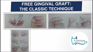 FREE GINGIVAL GRAFT: THE CLASSIC TECHNIQUE|PERIODONTAL PLASTIC AND ESTHETIC SURGERY|DR. ANKITA screenshot 3