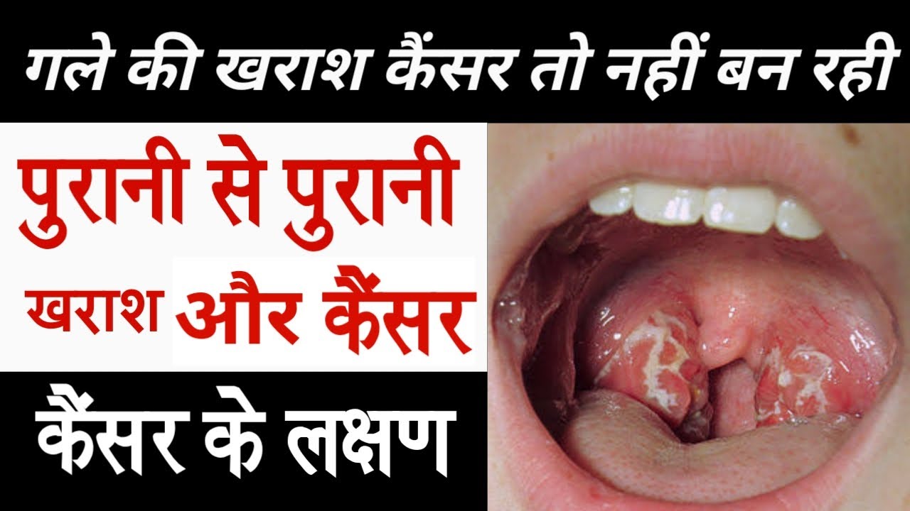 Gale Me Kharash Ke Upay In Hindi andre