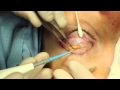 Live Surgery: Upper Blepharoplasty (Eyelid Lift) Part 2: Resection and Results