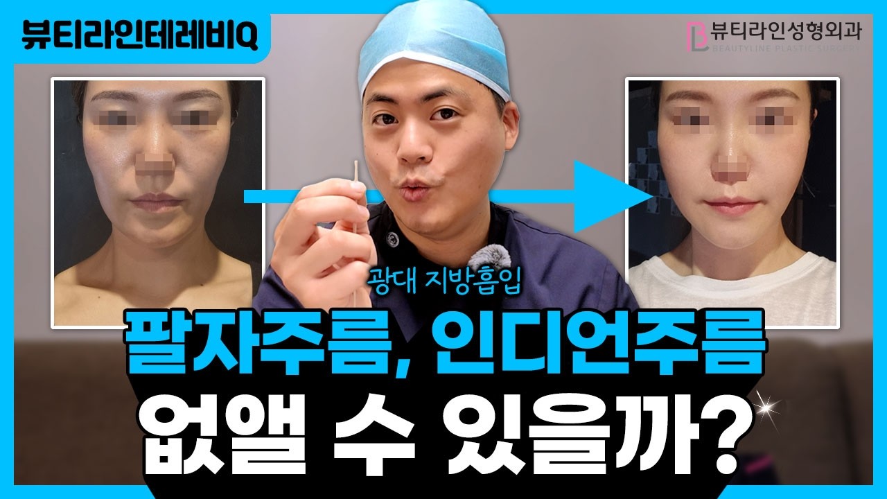 광대지방흡입 고민하고 있다면  참고할 영상 | 팔자주름, 인디언주름 없앨 수 있을까?